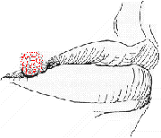 Fever blister Illustration - Herpes, febrile
