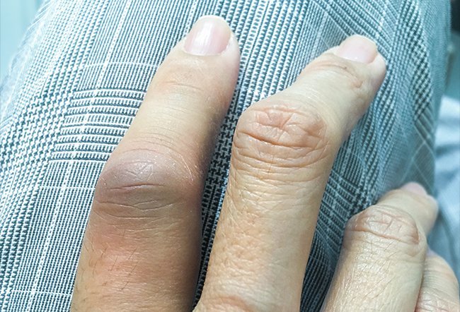 what causes swan neck deformity