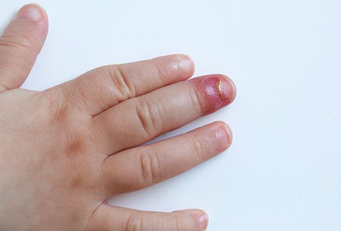 As finger infections tend to become more severe, there is limited scope for home remedies.