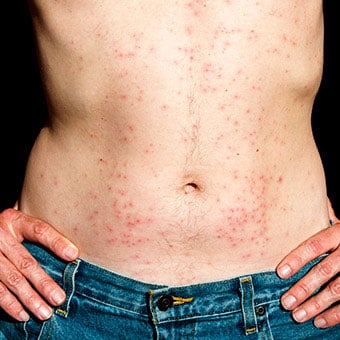 Small red bumps on the skin are a sign of folliculitis.