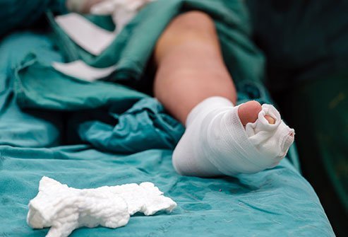  Foot reconstruction is a surgery performed to correct the anatomy of the foot and restore function.