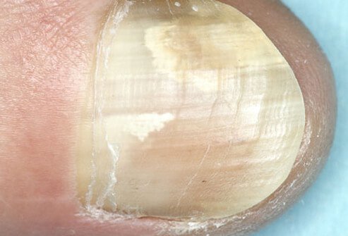 Occurring when microscopic fungi enter through a break in the nail or surrounding skin, a fungal infection can make your nails thick, discolored, and brittle.