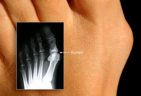 A bunion is a bony bump at the base of the big toe.