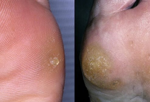 Picture of Corns and Calluses