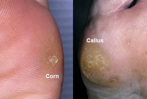 Friction and pressure cause corns and calluses.
