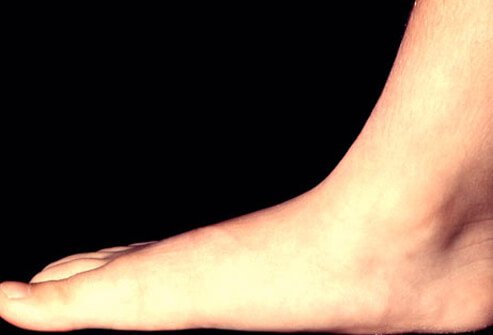 Flatfoot is a condition characterized by the sole of the foot coming into complete or near-complete contact with the ground when weight bearing.