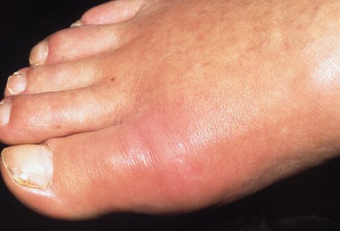 haracteristics of gout include redness, swelling, sudden pain, and stiffness, most commonly in the large joint of the big toe.