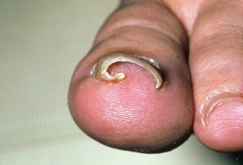 A toenail that has grown into the skin, an ingrown toenail can result in pain, redness, swelling, and even infection.