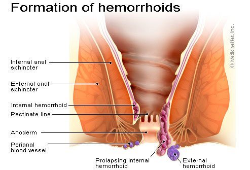 Hemorrhoid symptoms may go away with diet and lifestyle modifications. 