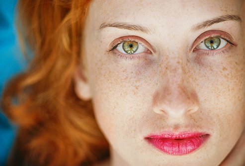 Freckles are harmless concentrations of melanin that cause dark spots on the skin.