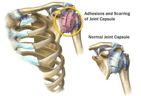 Strong connective tissue called the shoulder capsule surrounds the ball end of your upper arm bone and holds it to the socket.