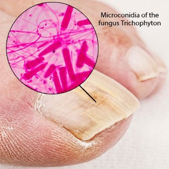 Microconidia of the fungus Trichophyton, which inhabit the soil and can lead to fungal infections of the skin, hair, or nails.
