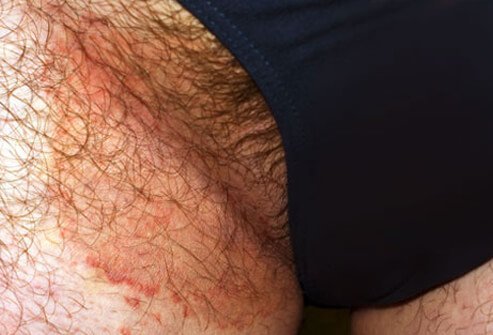 Jock itch is a fungal infection on the groin.