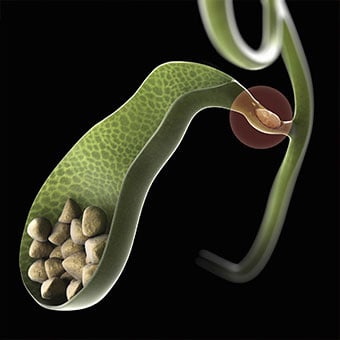 Bile ducts can become blocked, causing pain symptoms due to gallstones.