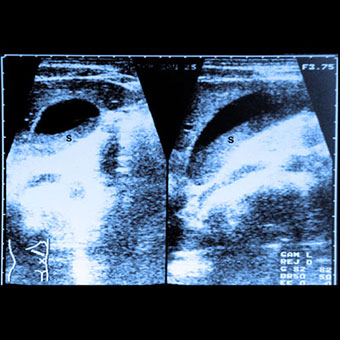 Longitudinal and axial scans through the gallbladder show layering of sludge (S) in the gallbladder.