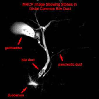 MRCP image showing stones in the common bile duct: (a) Gallbladder with stones (b) Stone in bile duct (c) Pancreatic duct (d) Duodenum.