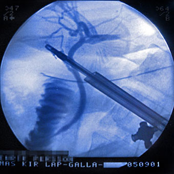 X-Ray during laparoscopic cholecystectomy.