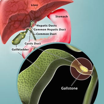 Illustration of the digestive system with gallstones and close up of gallstones in the gallbladder a stone that has also passed into the cystic duct.