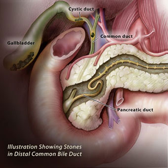 Illustration showing gallstones in the gallbladder as well as in the distal common bile duct.