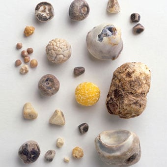 Collection of gallstones of various sizes and shapes.