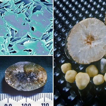 Small gallstones made up largely of cholesterol.