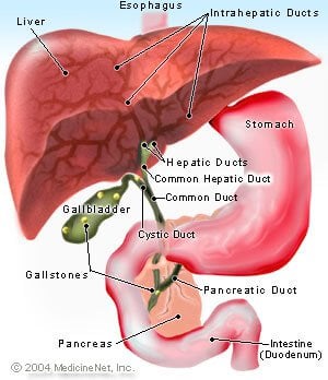 Illustration of Gallstones forming in the Gallbladder