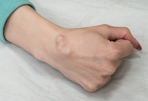 Picture of a ganglion cyst.