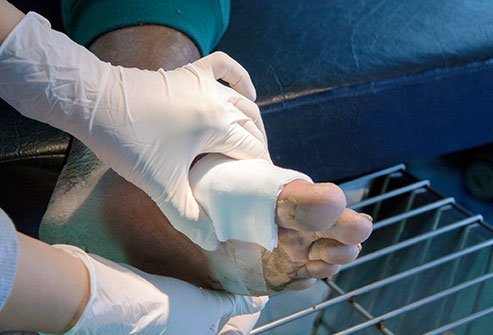 Wet gangrene is a medical emergency that needs prompt treatment.