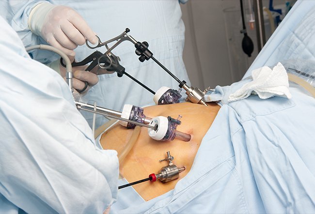Gastric bypass surgery, also known as a Roux-en-Y, is one kind of weight-loss surgery. You can live a normal live after gastric bypass but you have to change your diet, exercise and lifestyle habits. 