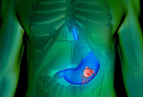 Gastric cancer is malignant disease of the stomach.