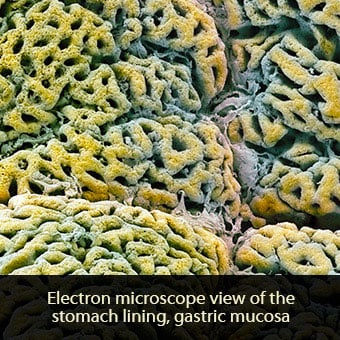Gastritis is caused by inflammation of the stomach lining also known as the gastric mucosa.