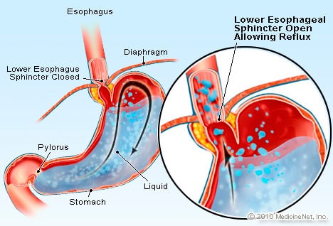 Gastroesophageal Reflux (GERD)