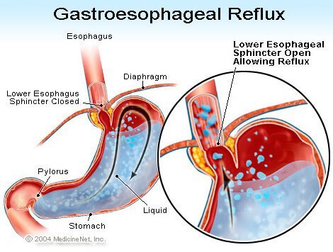 Gastroesophageal Reflux (GERD)