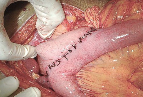 Image shows about 10 inches of sutures on internal organs, the anastomosis from the stomach to the mid small intestine.