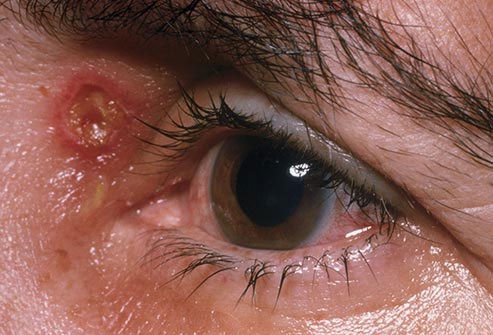 Take care to avoid spreading genital herpes to other parts of the body.