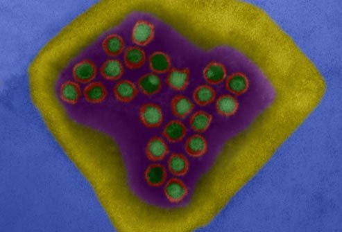 Herpes simplex-2 (HSV-2) causes genital herpes.