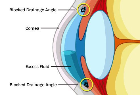 Glaucoma can result from a variety of diseases.