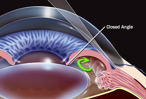 Some forms of glaucoma can come on suddenly.