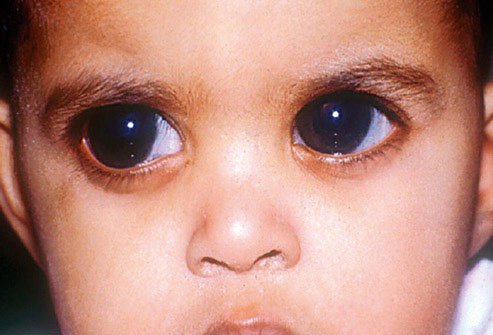 Some children are born with glaucoma.