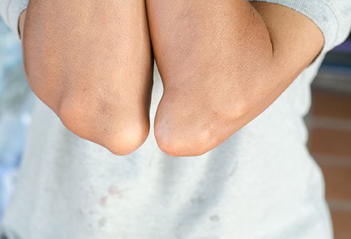 Urticaria is the medical term for hives. The best treatment for urticaria include medications, home care/remedies and alternative treatments.