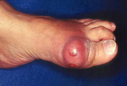 The large joint at the base of the big toe (first metatarsophalangeal joint) is the most common site for a gout attack but other joints commonly affected are the ankles, knees, wrists, fingers, and elbows.