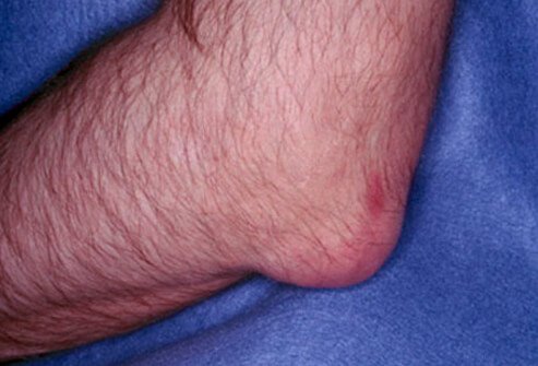 Here is an example of gout affecting the elbow.
