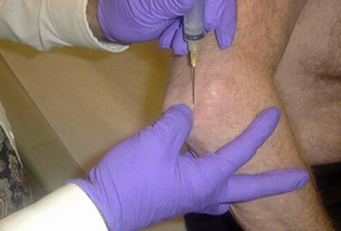Gout is usually diagnosed by a doctor based on the location of the inflamed joint and a history of having similar non-traumatic attacks of pain and swelling.