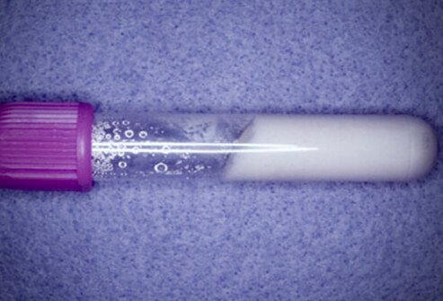 This fluid was obtained from crystal deposits in a patient with gout.