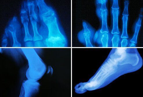 The large joint at the base of the big toe (first metatarsophalangeal metatarsalphylangeal joint) is the most common site for a gout attack, however, any other joint can be affected.