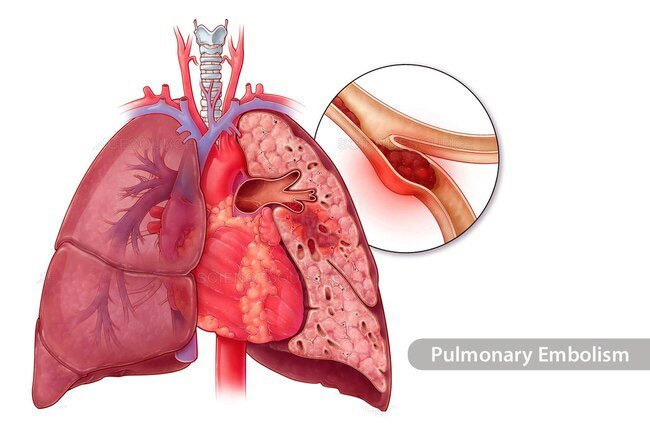 Venous thromboembolism happens when a blood clot forms in deep veins.