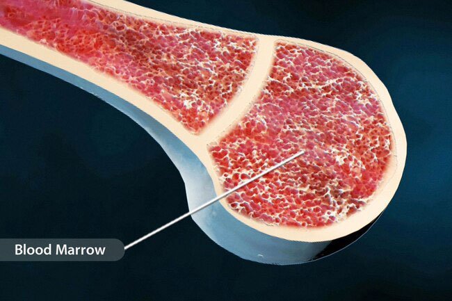 Multiple myeloma is another type of blood cancer.