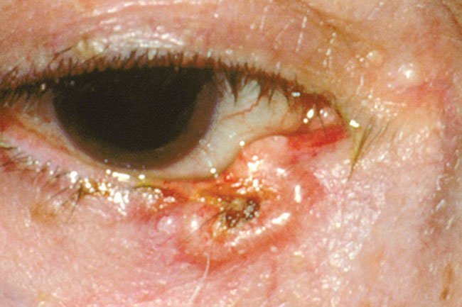 Eyelid cancer may form due to excess sun exposure.