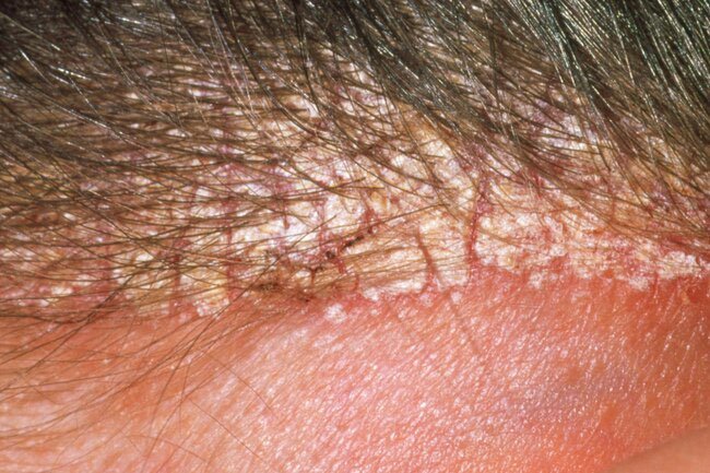 Seborrheic dermatitis is common on the scalp where it can cause dry flakes (dandruff) as well as greasy, red, thickened skin.