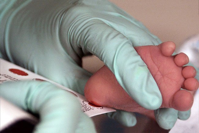 Babies are screened for sickle cell disease shortly after birth.